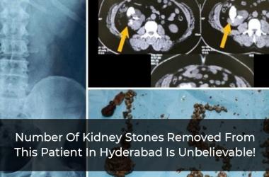 Number Of Kidney Stones Removed From This Patient In Hyderabad Is Unbelievable!