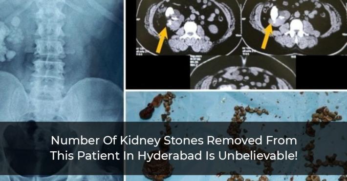 Number Of Kidney Stones Removed From This Patient In Hyderabad Is Unbelievable!