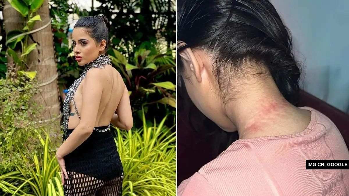 Outfit Experiment Gone Wrong Urfi Javed Gets Bruised After Wearing Top Made Of Chains